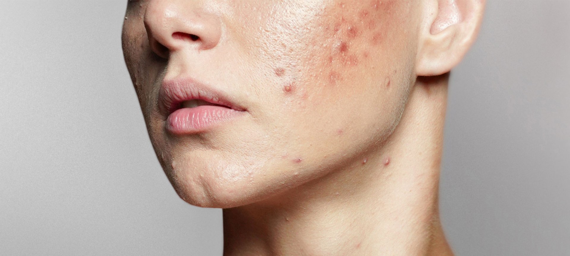 Untere Gesichtshälfte und Hals einer Frau im Schrägprofil. Über die linke Wange zieht sich ein breiter Streifen roter, entzündeter Pickel.