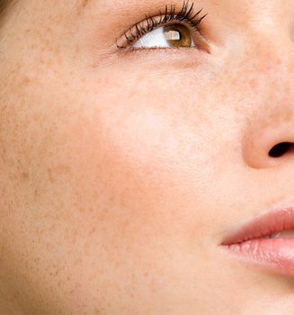 Nahaufnahme des Gesichts einer jungen Frau mit Sommersprossen/Pigmentflecken auf Wangen und Nase