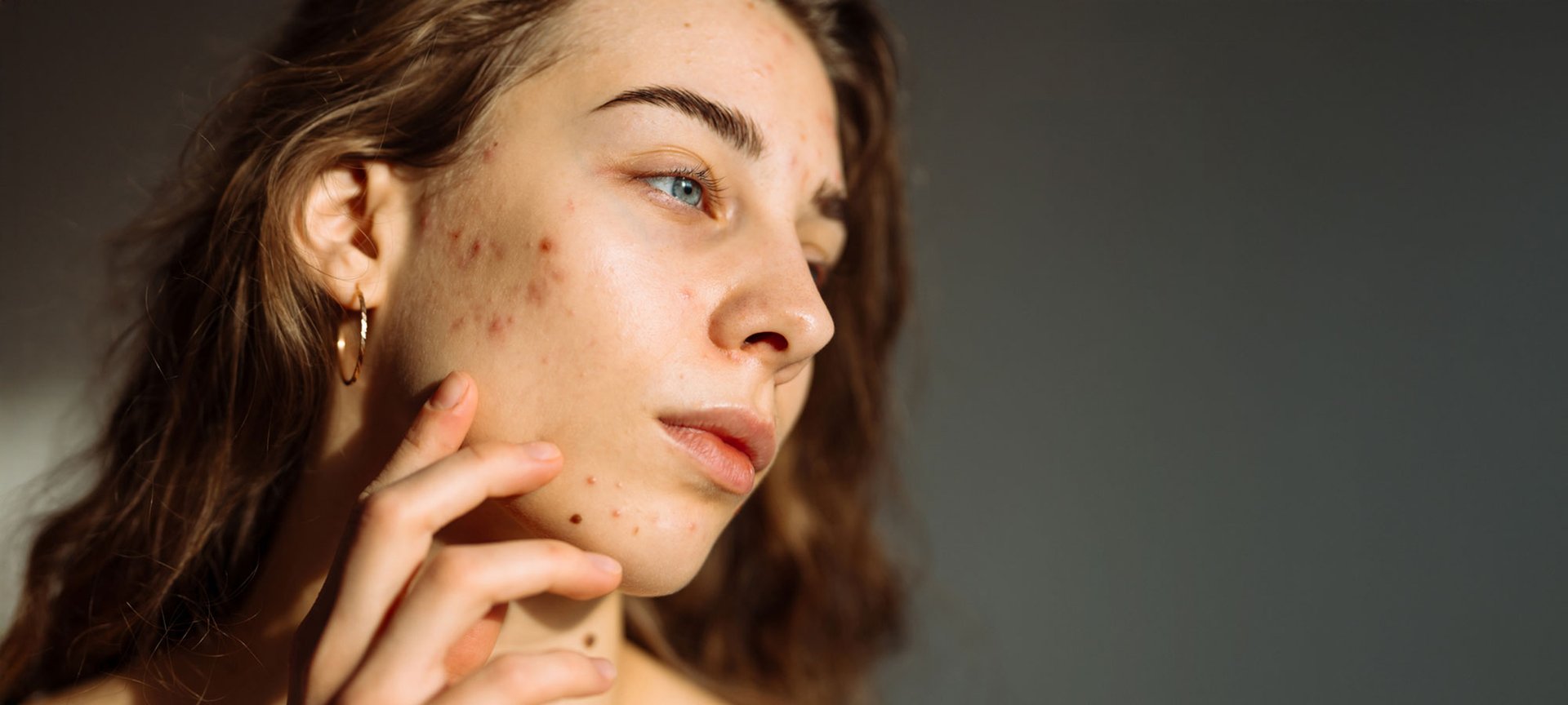 Braunhaarige Frau im Halbprofil von rechts, mit einige Pickeln zwischen Jochbein und Ohr.