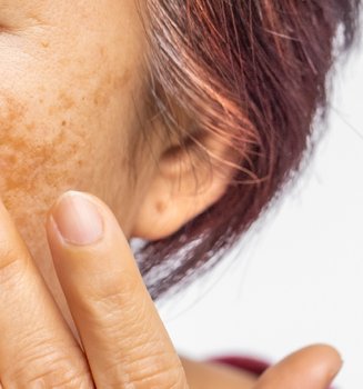 Nahaufnahme einer älteren Frau mit Melasma im Gesicht
