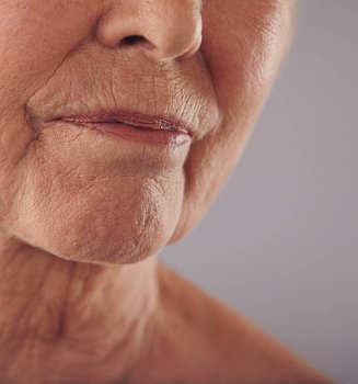 Nahaufnahme der unteren Gesichtshälfte einer älteren Frau mit Marionettenfalten am Mund