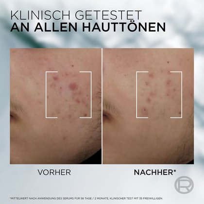Vorher-Nachher-Schaubild: links unreine Haut, rechts glättere, reinere Haut