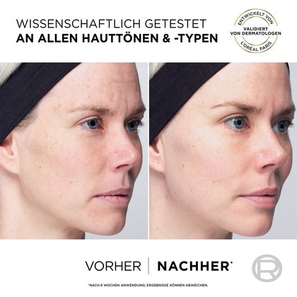 Seitenansicht eines Gesichts einer jungen Farau als Anwendungsbeispiel mittels vorher / nachher Vergleich
