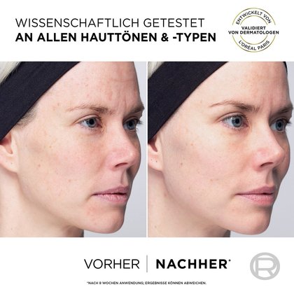 Seitenansicht eines Gesichts einer jungen Farau als Anwendungsbeispiel mittels vorher / nachher Vergleich